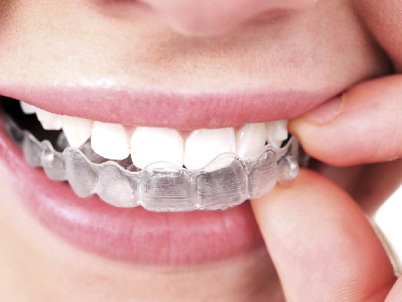 Invisalign
